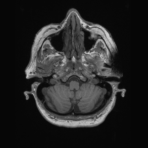 File:Basal ganglia metastasis (Radiopaedia 78928-91828 Axial T1 10).png