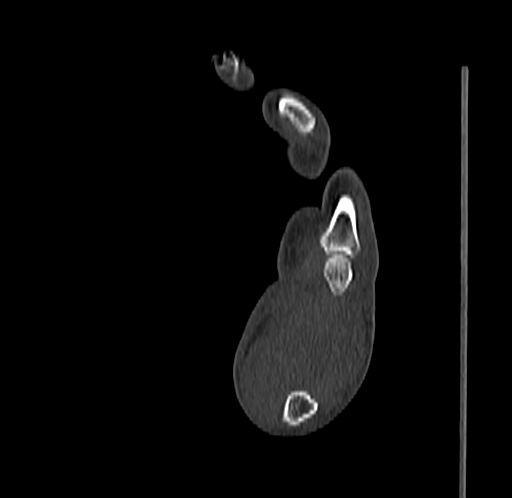 Base of 2nd metacarpal fracture (Radiopaedia 73741-84544 Sagittal bone window 75).jpg