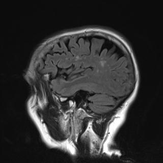 File:Base of skull chondrosarcoma (Radiopaedia 30410-31070 Sagittal FLAIR 21).jpg