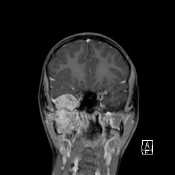Base of skull rhabdomyosarcoma (Radiopaedia 32196-33142 I 29).jpg