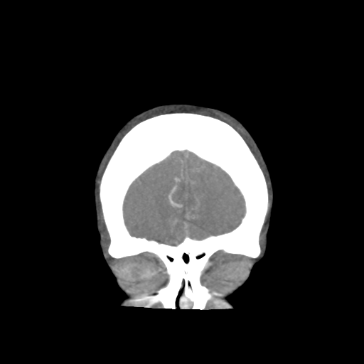 Basilar and bilateral vertebral artery occlusion (Radiopaedia 45592-49723 B 15).png