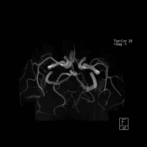 Basilar tip aneurysm (Radiopaedia 26504-26632 D 10).jpg
