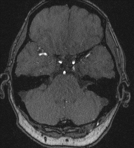 Basilar tip aneurysm (Radiopaedia 26504-26632 MRA 60).jpg