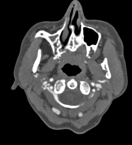 File:Basilar tip aneurysm with coiling (Radiopaedia 53912-60086 A 3).jpg