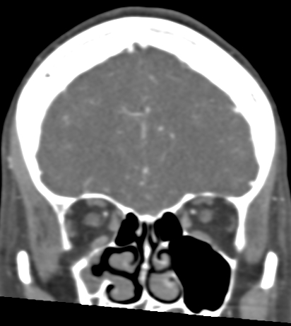 Basilar tip aneurysm with coiling (Radiopaedia 53912-60086 B 31).jpg