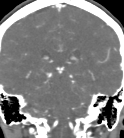 Basilar tip aneurysm with coiling (Radiopaedia 53912-60086 B 98).jpg