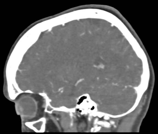 Basilar tip aneurysm with coiling (Radiopaedia 53912-60086 C 94).jpg