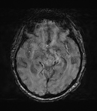 File:Behavioral variant frontotemporal dementia and late onset schizophrenia (Radiopaedia 52197-58083 Axial SWI 31).png