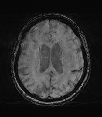 File:Behavioral variant frontotemporal dementia and late onset schizophrenia (Radiopaedia 52197-58083 Axial SWI 47).png