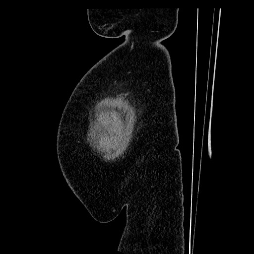 Benign leiomyoma with hydropic features (Radiopaedia 89250-106130 C 1).jpg