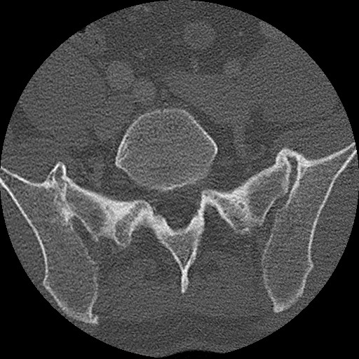Benign post-traumatic pseudopneumoperitoneum (Radiopaedia 71199-81495 Axial bone window 281).jpg