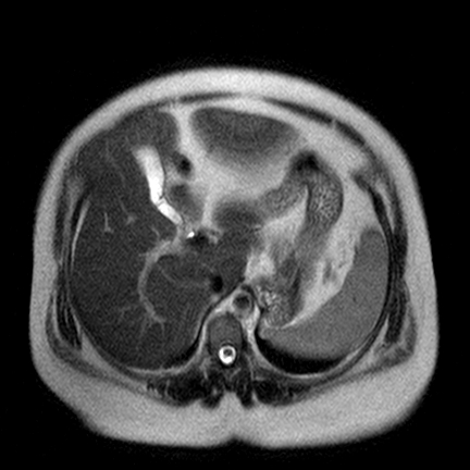 File:Benign seromucinous cystadenoma of the ovary (Radiopaedia 71065-81300 Axial T2 16).jpg