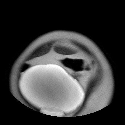 File:Benign seromucinous cystadenoma of the ovary (Radiopaedia 71065-81300 Coronal T2 6).jpg