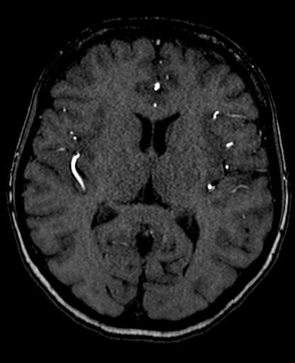 Berry aneurysm of the terminal internal carotid artery (Radiopaedia 88286-104918 Axial TOF 135).jpg