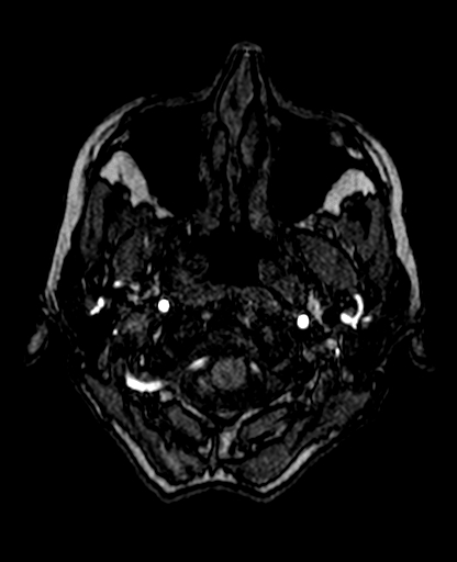 File:Berry aneurysm of the terminal internal carotid artery (Radiopaedia 88286-104918 Axial TOF 38).jpg