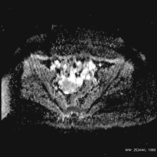 File:Bicornuate uterus- on MRI (Radiopaedia 49206-54297 Axial ADC 11).jpg