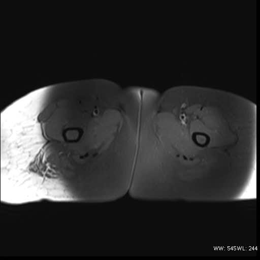 File:Bicornuate uterus- on MRI (Radiopaedia 49206-54297 Axial T1 fat sat 24).jpg