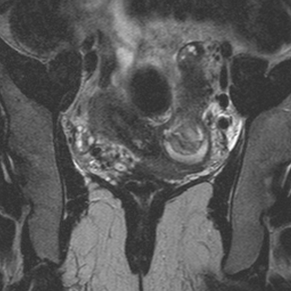 File:Bicornuate uterus (Radiopaedia 24677-24949 Coronal T2 9).jpg