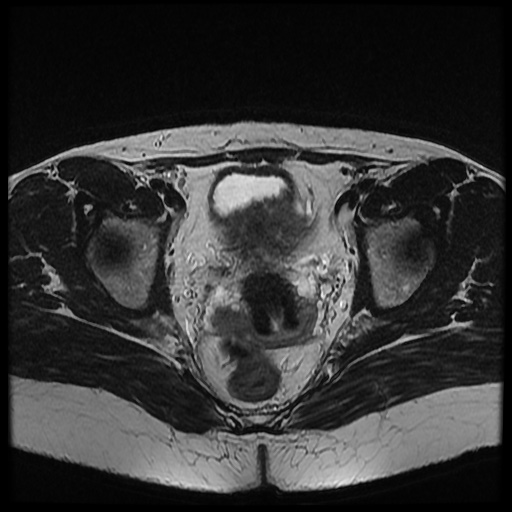 File:Bicornuate uterus (Radiopaedia 51676-57472 Axial T2 16).jpg