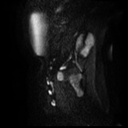 File:Bicornuate uterus (Radiopaedia 51676-57472 Sagittal DWI 30).jpg