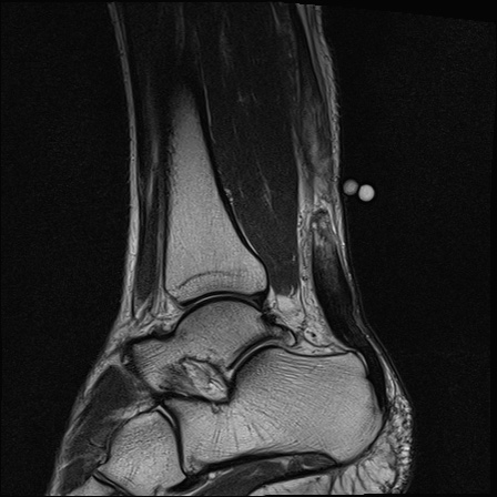 File:Bilateral Achilles tendon complete tear (Radiopaedia 81344-95051 Sagittal T2 24).jpg