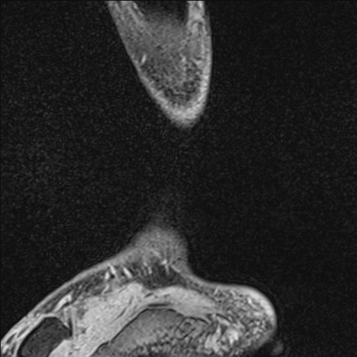 File:Bilateral Achilles tendon complete tear (Radiopaedia 81344-95051 Sagittal WE - Left 21).jpg