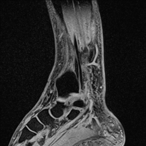 Bilateral Achilles tendon complete tear (Radiopaedia 81344-95051 Sagittal WE - Right 76).jpg