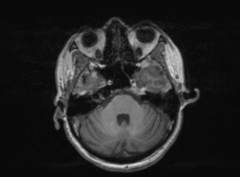 Bilateral PCA territory infarction - different ages (Radiopaedia 46200-51784 Axial T1 299).jpg