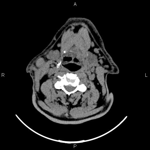 Bilateral Warthin tumors (Radiopaedia 84034-99263 Axial non-contrast 34).jpg