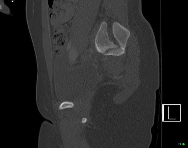 Bilateral acetabular fractures (Radiopaedia 79272-92308 Sagittal bone window 33).jpg