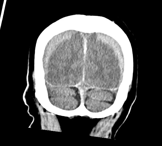 File:Bilateral acute on chronic subdural hematomas (Radiopaedia 78466-91146 Coronal non-contrast 58).jpg