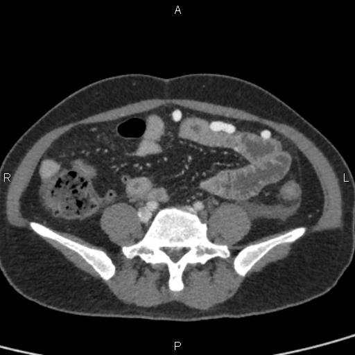 Bilateral adrenal gland hyperenhancement in pancreatitis (Radiopaedia 86642-102753 E 77).jpg