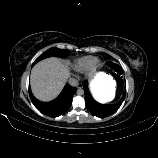 File:Bilateral adrenal myelolipoma (Radiopaedia 63058-71535 Axial non-contrast 12).jpg
