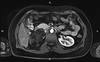 Bilateral adrenal myelolipoma (Radiopaedia 63058-71537 Axial T1 C+ fat sat 43).jpg