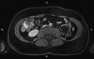 Bilateral adrenal myelolipoma (Radiopaedia 63058-71537 G 64).jpg