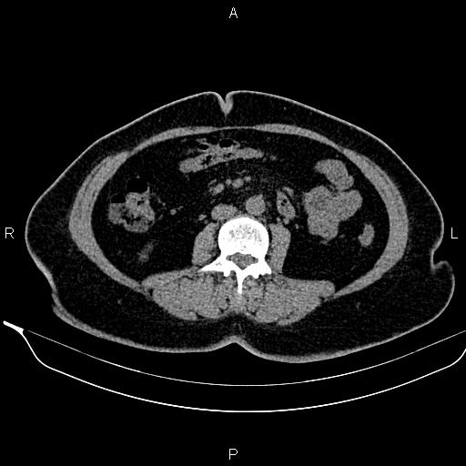 Bilateral benign adrenal adenomas (Radiopaedia 86912-103124 Axial non-contrast 61).jpg