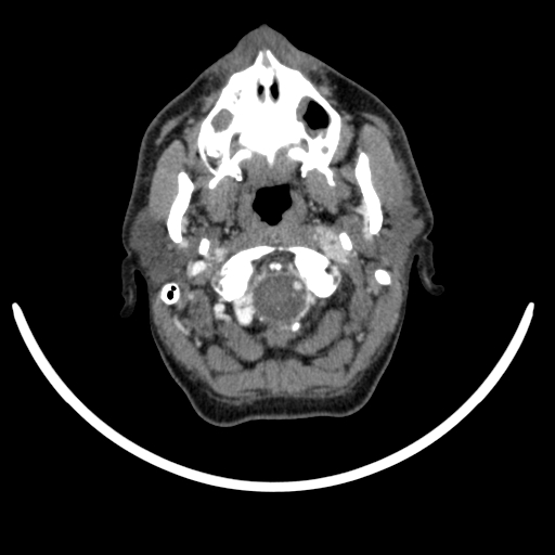 Bilateral carotid body tumors (Radiopaedia 52899-58827 A 44).jpg