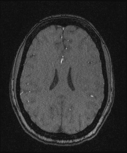 Bilateral carotid body tumors and right glomus jugulare tumor (Radiopaedia 20024-20060 Axial MRA 120).jpg