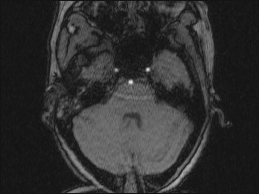 Bilateral carotid body tumors and right glomus jugulare tumor (Radiopaedia 20024-20060 Axial MRA 321).jpg
