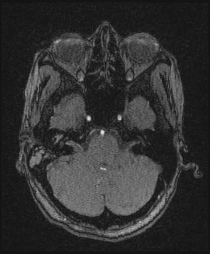 Bilateral carotid body tumors and right glomus jugulare tumor (Radiopaedia 20024-20060 Axial MRA 43).jpg