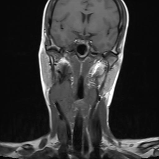 File:Bilateral carotid body tumors and right jugular paraganglioma (Radiopaedia 20024-20060 Coronal 6).jpg