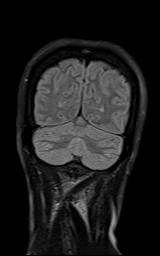 File:Bilateral carotid body tumors and right jugular paraganglioma (Radiopaedia 20024-20060 Coronal 66).jpg