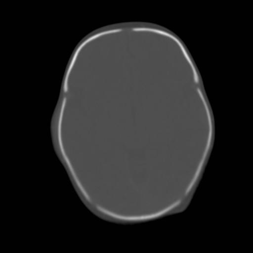 File:Bilateral cephalohematomas and subdural hematomas (Radiopaedia 26778-26929 Axial bone window 10).jpg