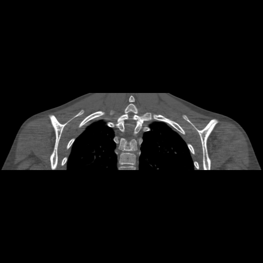 File:Bilateral chronic posterior shoulder dislocation (Radiopaedia 39213-41452 Coronal bone window 44).jpg