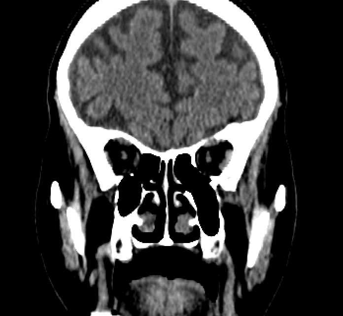 Bilateral ectopia lentis (Radiopaedia 89889-107013 Coronal non-contrast 82).jpg