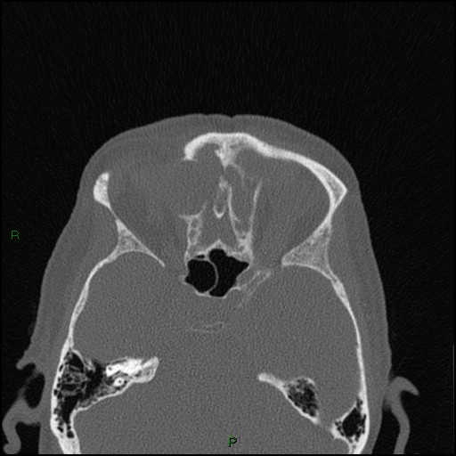 File:Bilateral frontal mucoceles (Radiopaedia 82352-96454 Axial bone window 126).jpg