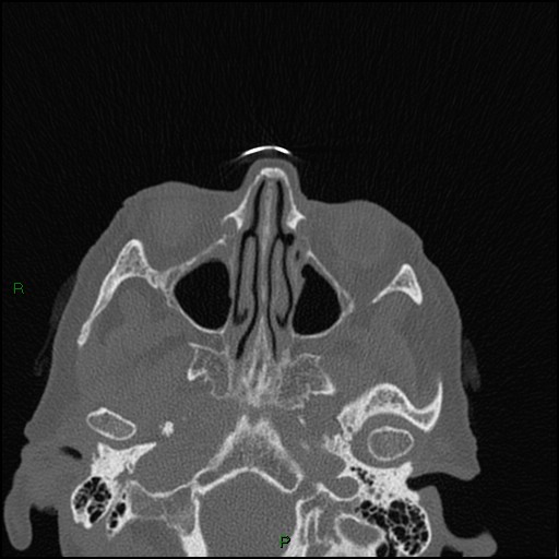 Bilateral frontal mucoceles (Radiopaedia 82352-96454 Axial bone window 173).jpg