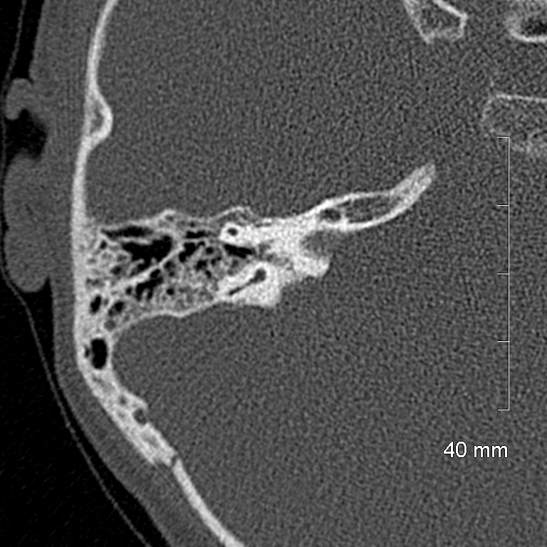 Bilateral grommets (Radiopaedia 47710-52404 Axial bone window 51).jpg