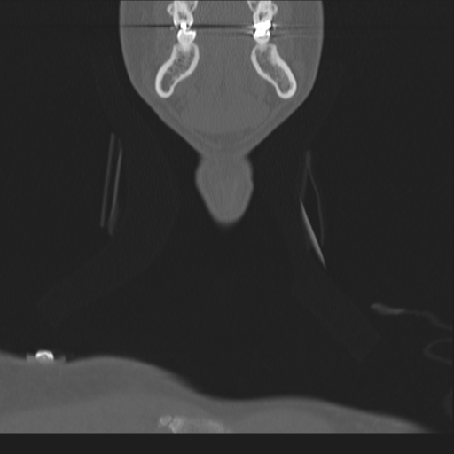 Bilateral locked facets (Radiopaedia 33850-35016 Coronal bone window 4).png