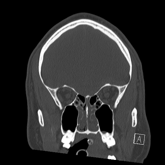 Bilateral occipital condyle fracture (type 2) (Radiopaedia 87675-104089 Coronal bone window 24).jpg